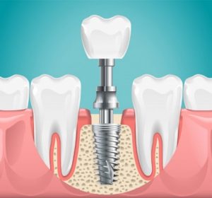 Model of dental implants