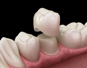 A 3D illustration of a tooth prepped for a dental crown