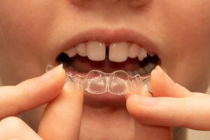 Invisalign used for fixing gapped teeth